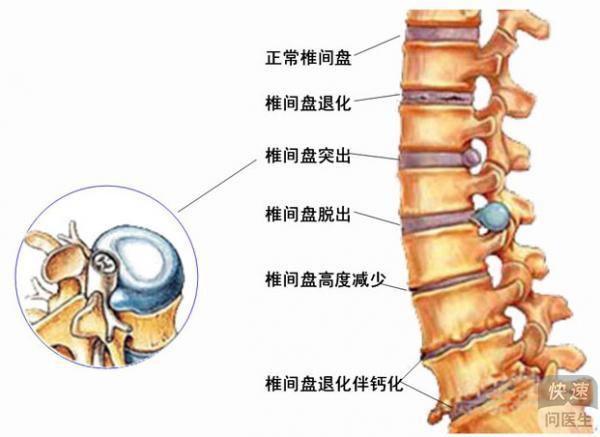 腰椎间盘突出最新疗法｜腰椎间盘突出治疗新突破